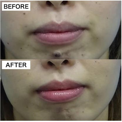 TCB東京中央美容外科のほくろ除去の症例