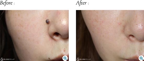 電気凝固法によるほくろ除去の聖心美容クリニックの症例