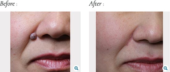 切開法によるほくろ除去の聖心美容クリニックの症例