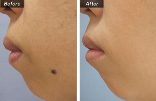 電気分解法の症例（城本クリニック）