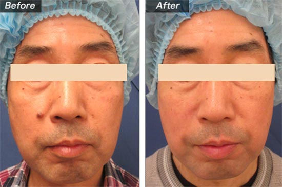 切縫法の症例（城本クリニック）男性