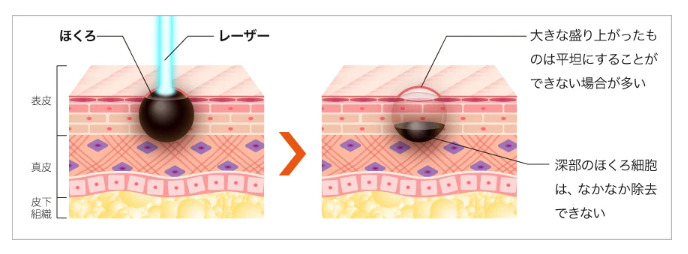炭酸ガスレーザー