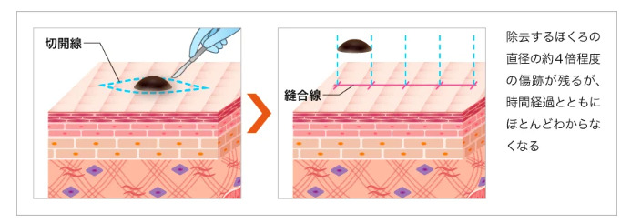切除法（メス切開