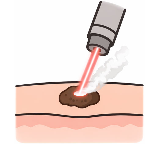 炭酸ガスレーザー（CO₂レーザー）