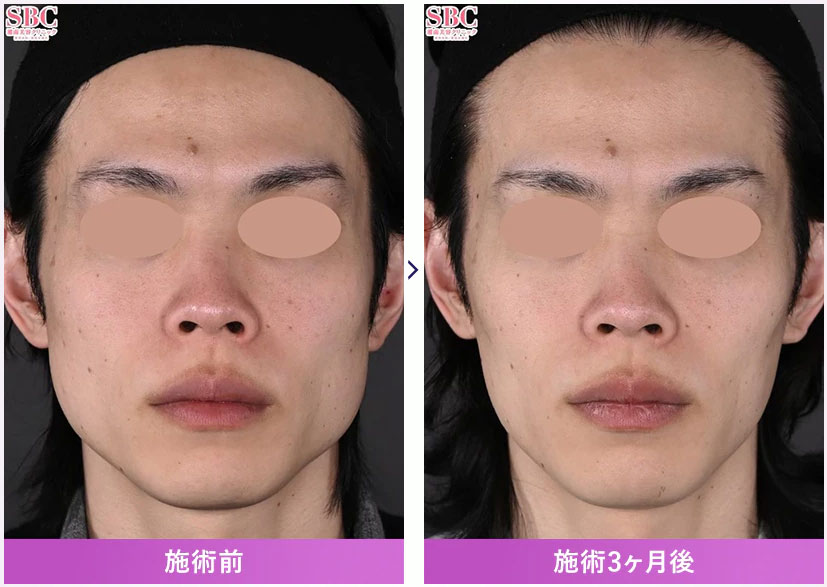 湘南美容クリニックのエラボトックスの症例画像