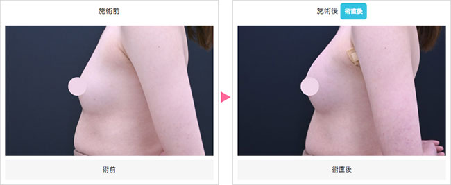 ヒアルロン酸豊胸の省理恵