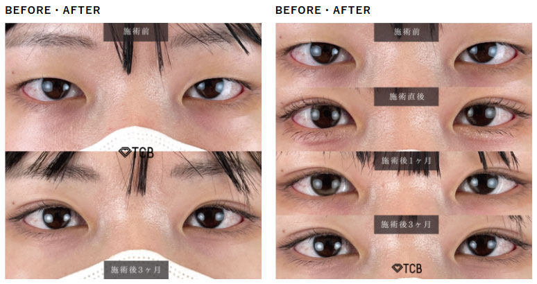 二重埋没法 福岡天神院