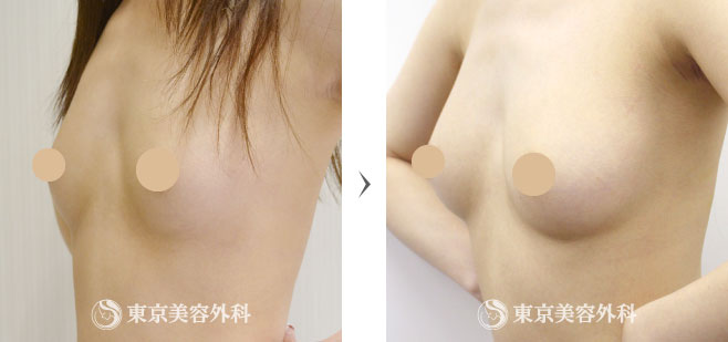 豊胸（脂肪注入）の症例