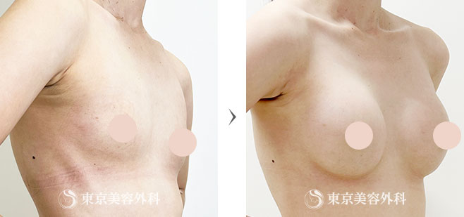 シリコンバッグ豊胸の症例写真